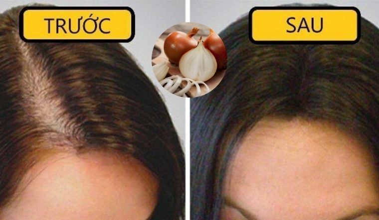 trước và sau khi sử dụng các sản phẩm kích thích mọc tóc