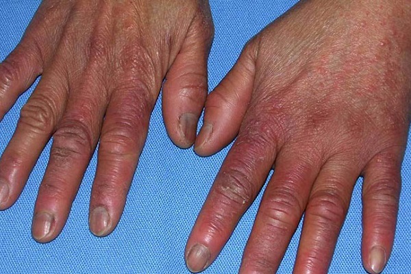 mu bàn tay đen là cho tác hại từ tia UV