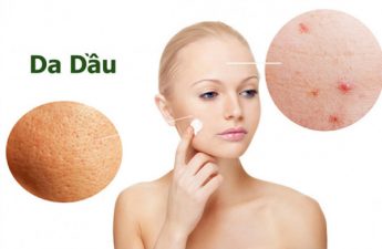 da dầu thường để lại nhiều mụn ẩn